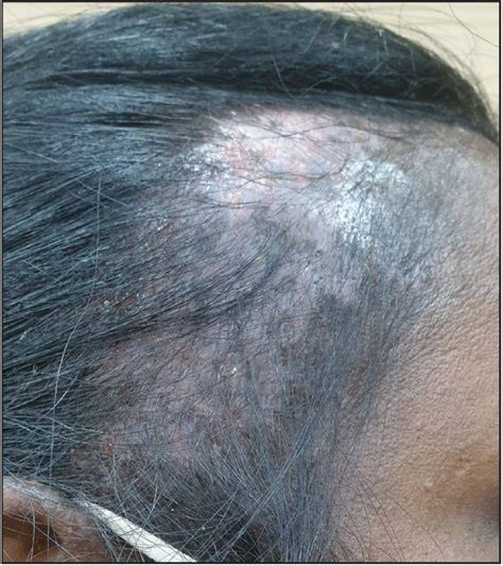 What are the side effects of hair dye?