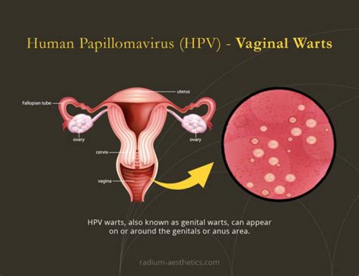 What are the signs of an HPV flare up?