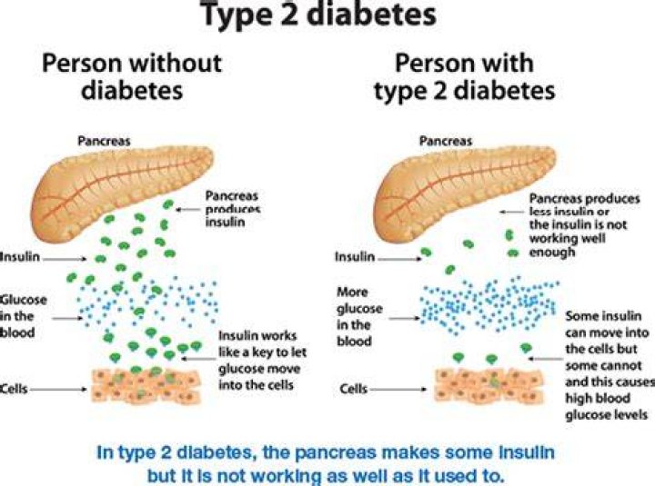 What are the stages of type 2 diabetes?
