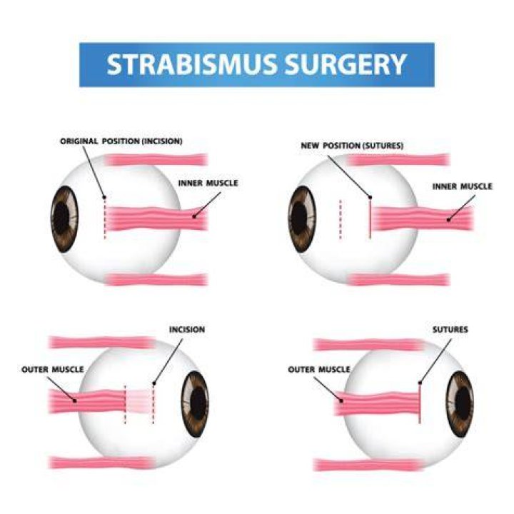 What can go wrong with strabismus surgery?