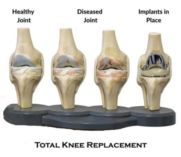 What can you do instead of having a knee replacement?