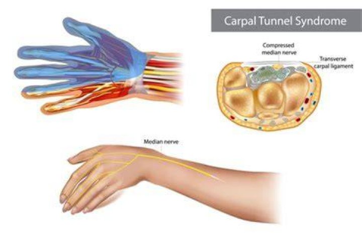 What causes pressure on the median nerve?