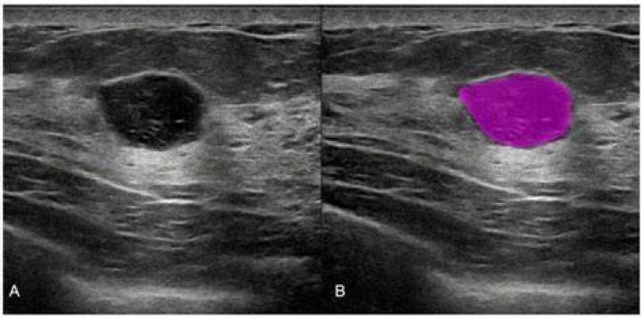 What color are tumors on an ultrasound?
