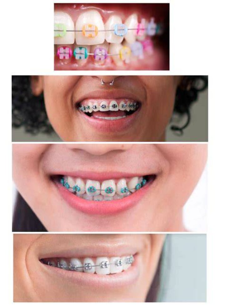 What color braces are most attractive?
