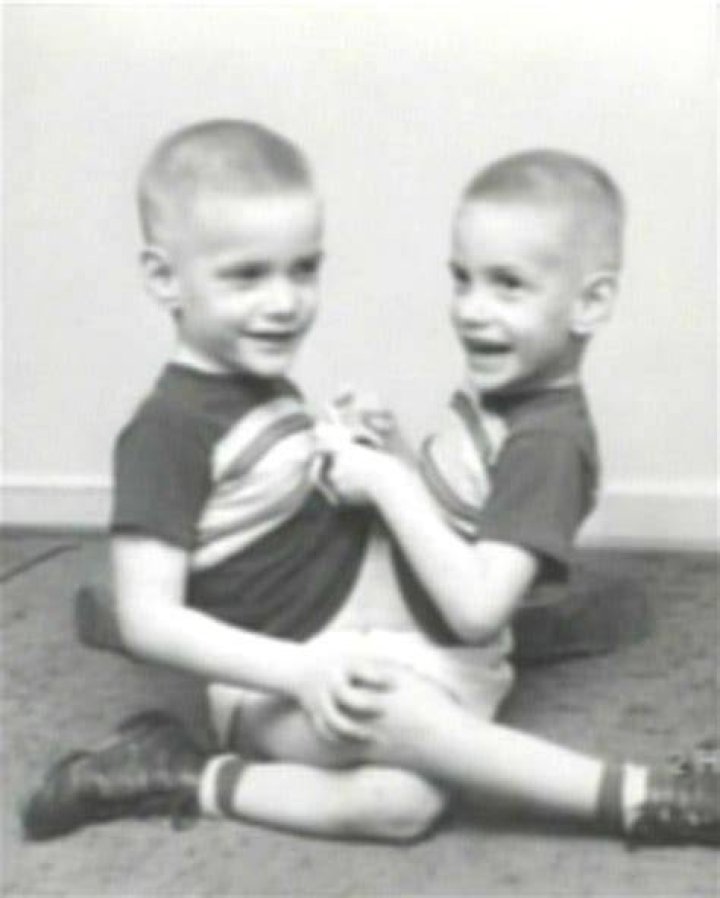 What did the conjoined twins Ronnie and Donnie died from?