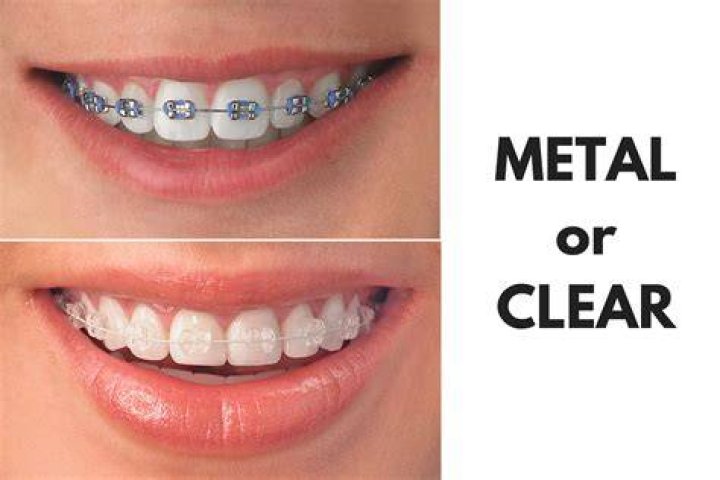 What do braces without wires do?