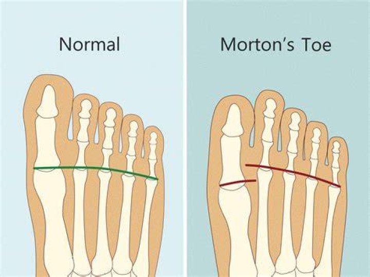 What do red toes mean?