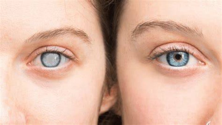 What do the eyes of a dying person look like?