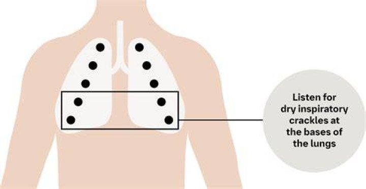 What does a crackle on the lung mean?