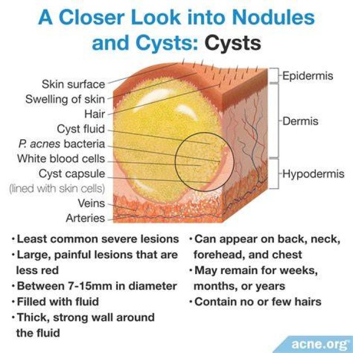 What does a cyst look like?