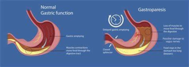 What does a gastroparesis flare up feel like?