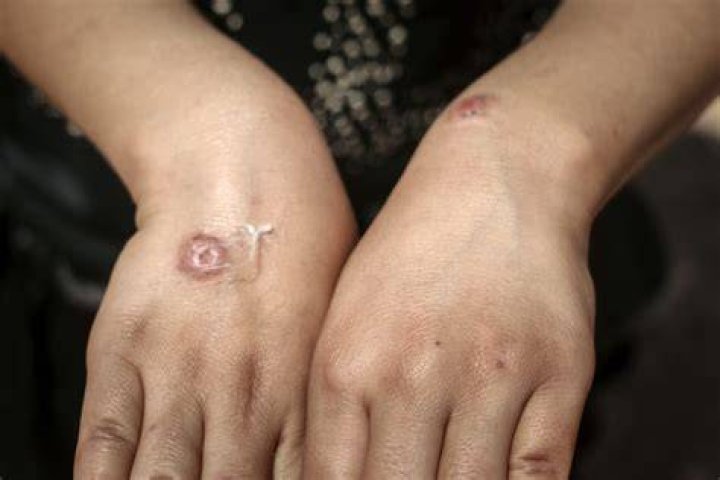 What does a parasite look like on your skin?