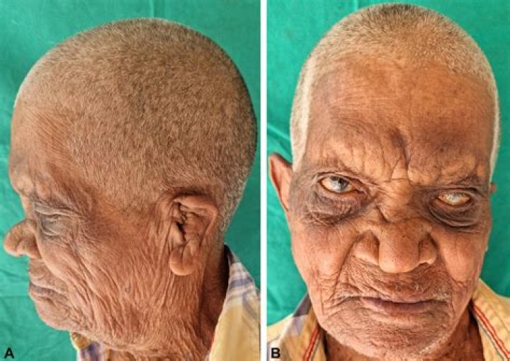 What does a person with leprosy look like?