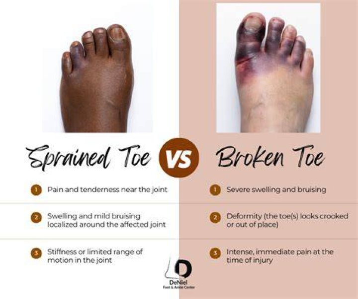 What does a sprained toe look like?