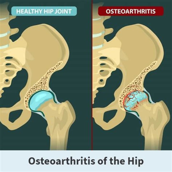 What does hip arthritis feel like?