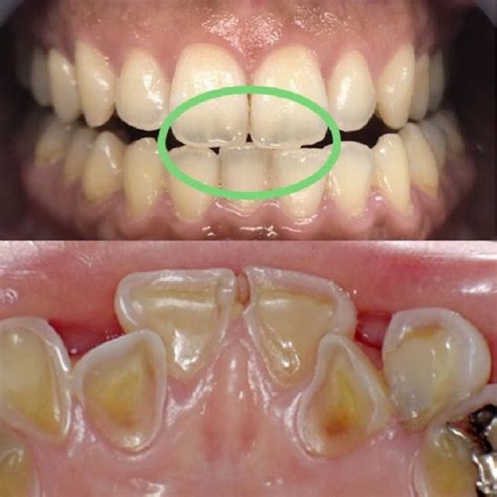 What does tooth enamel loss look like?