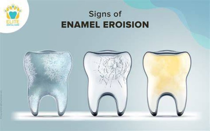 What does weak tooth enamel look like?