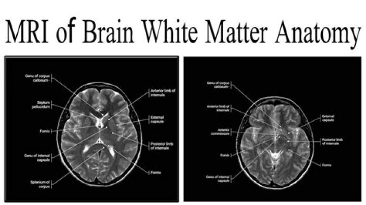 What does white matter in brain MRI mean?