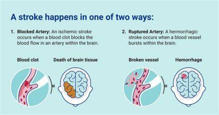 What happens after a stroke in the hospital?