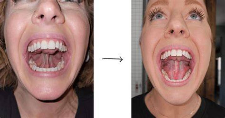 What happens after tongue-tie release in adults?