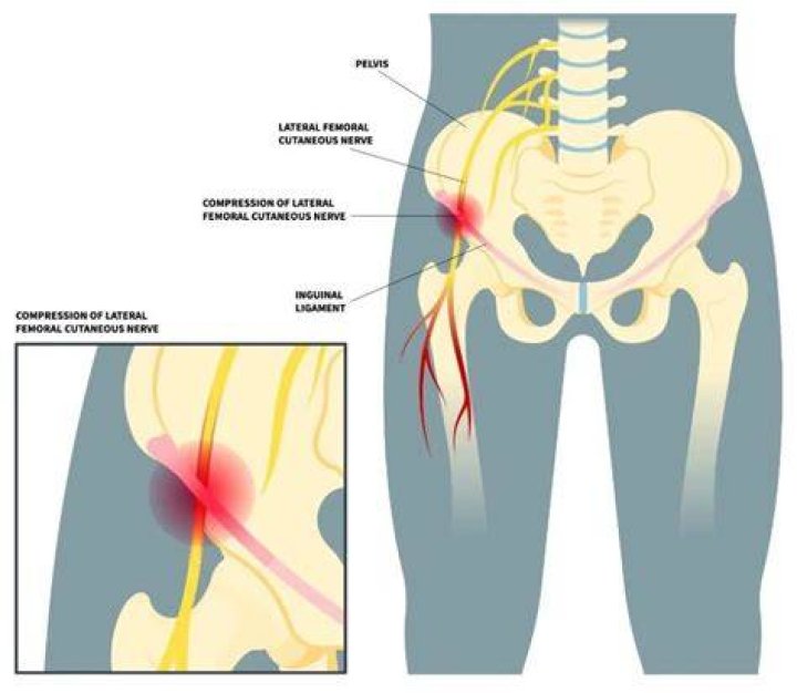 What happens if meralgia paresthetica goes untreated?