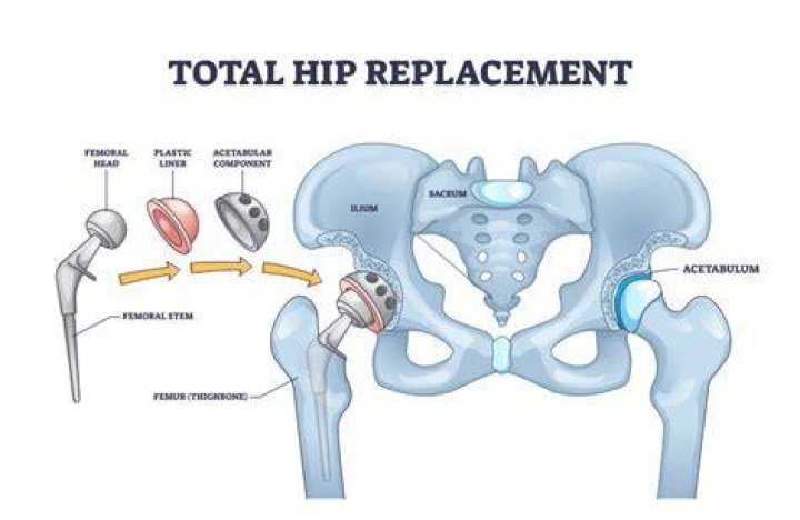 What happens if you need a hip replacement and don't get one?