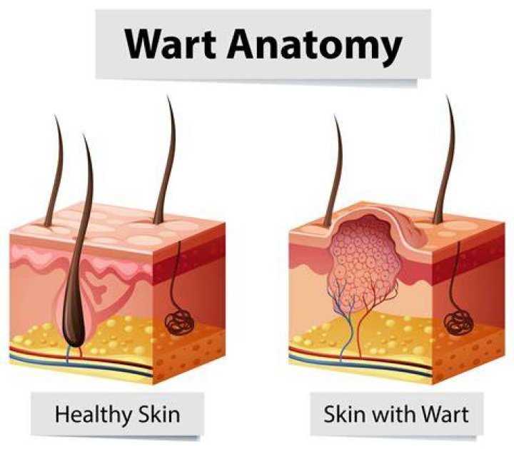 What happens if you pull out a wart?