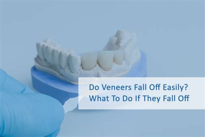 What happens when veneers fall off?