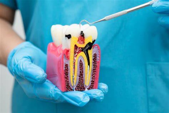 What hurts more extraction or root canal?