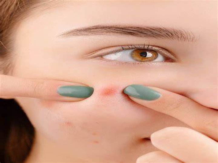 What is a blind pimple?