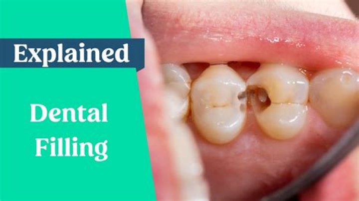 What is a Class 2 filling?