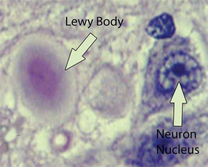 What is a Lewy body?