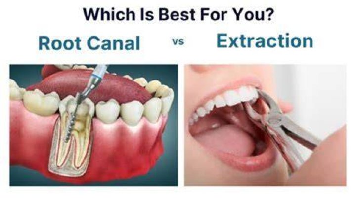 What is cheaper a root canal or extraction?