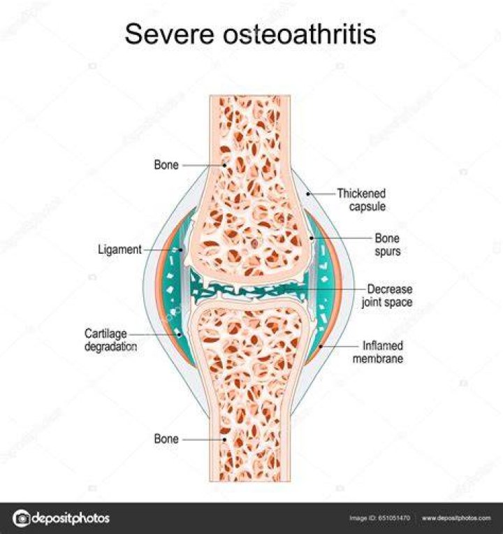 What is considered severe osteoarthritis?