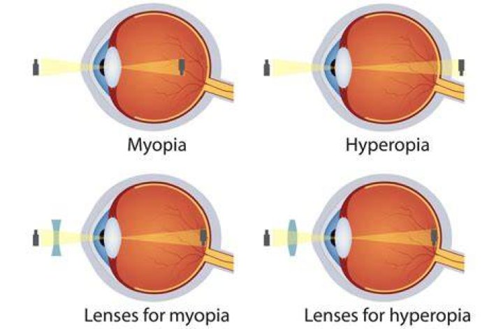 What is hyperoptic vision?