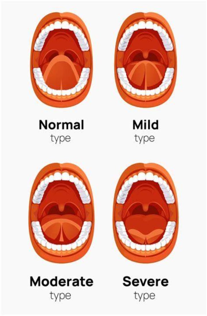 What is mild tongue-tie?
