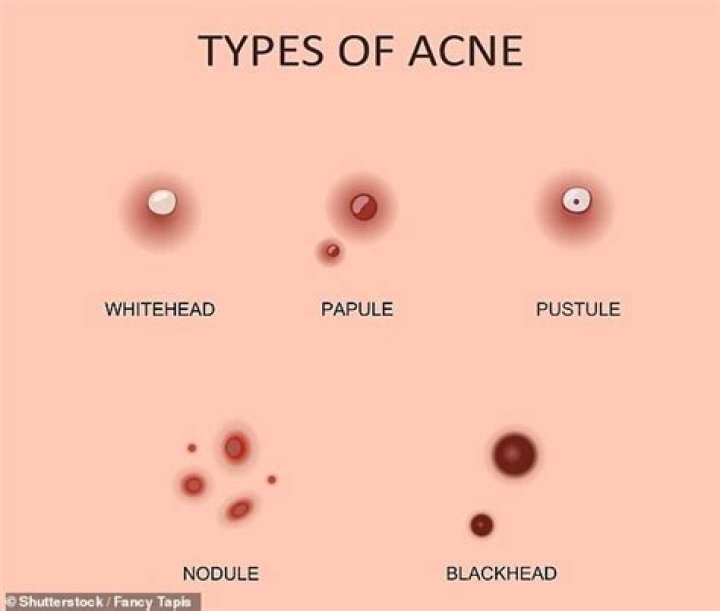 What is that hard white core in a pimple?