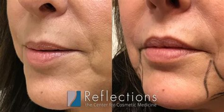 What is the best filler for upper lip wrinkles?