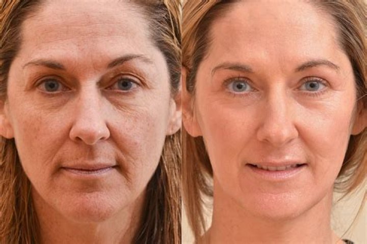 What is the best laser treatment for your face?