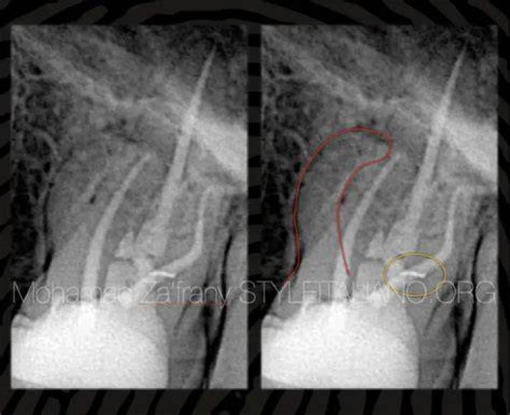 What is the failure rate of root canals?