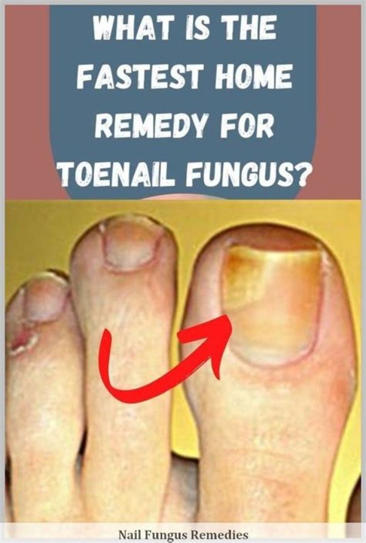 What is the fastest home remedy for toenail fungus?