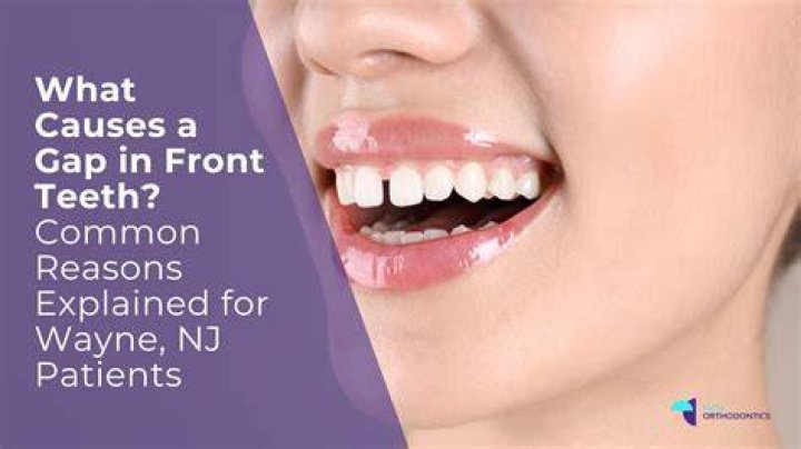 What is the gap in front teeth called?