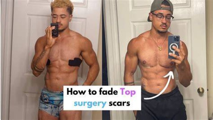 What is top surgery for a woman?