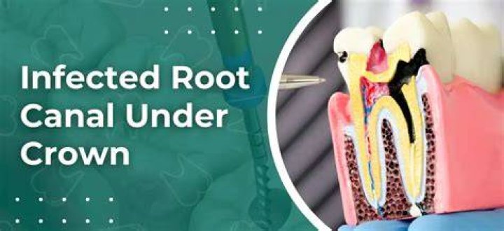 What is worse a crown or root canal?