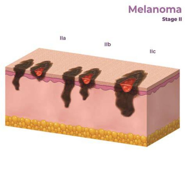 What percent of melanoma is fatal?