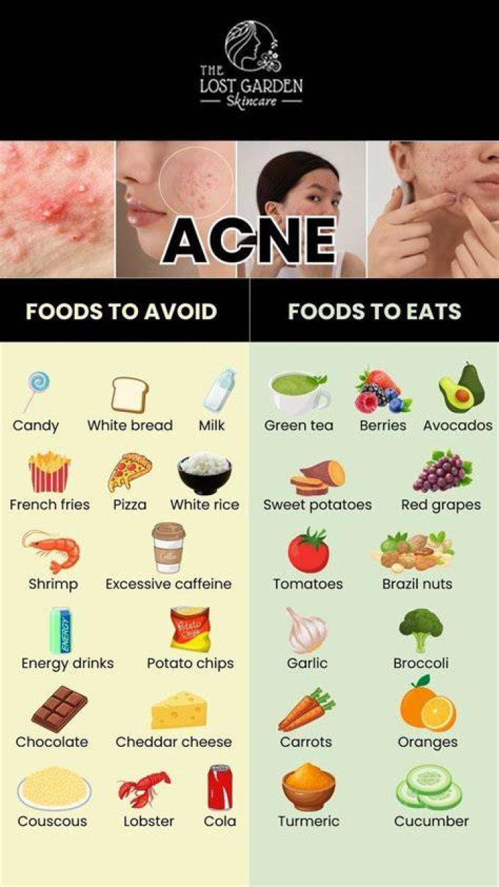 What should you not do with acne?