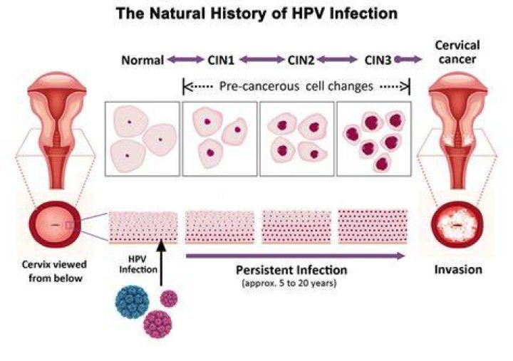 What type of HPV causes CIN 3?