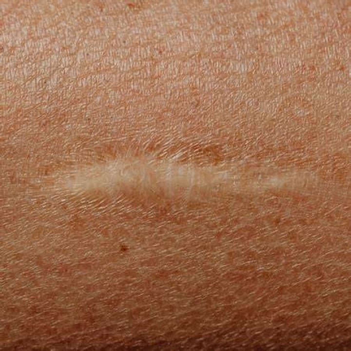 What type of scars turn white?