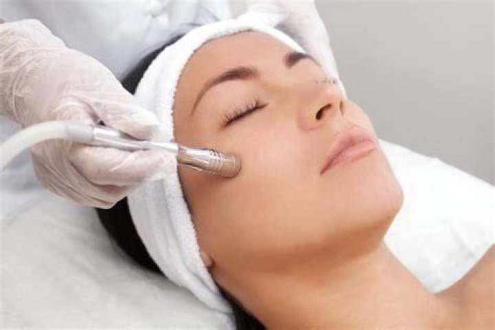 What type of skin is microdermabrasion good for?