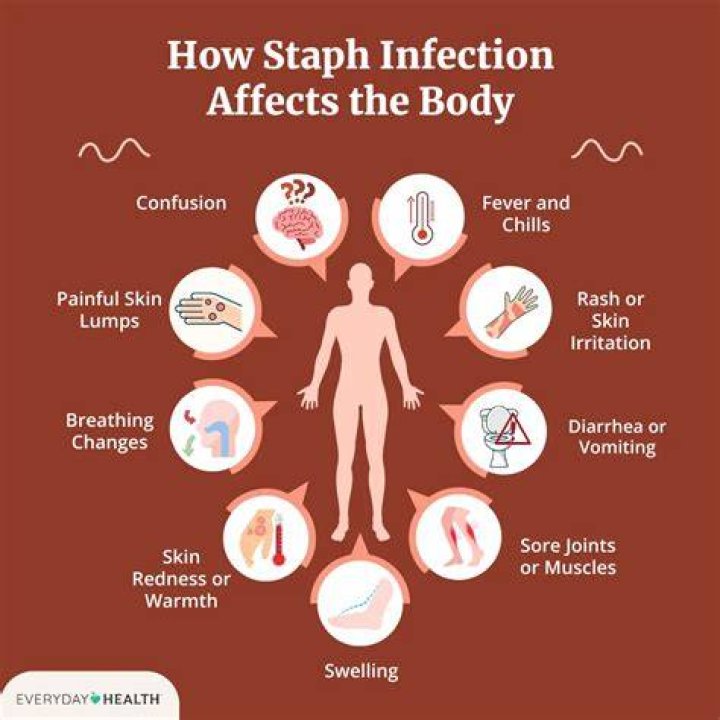 When should I be worried about a staph infection?